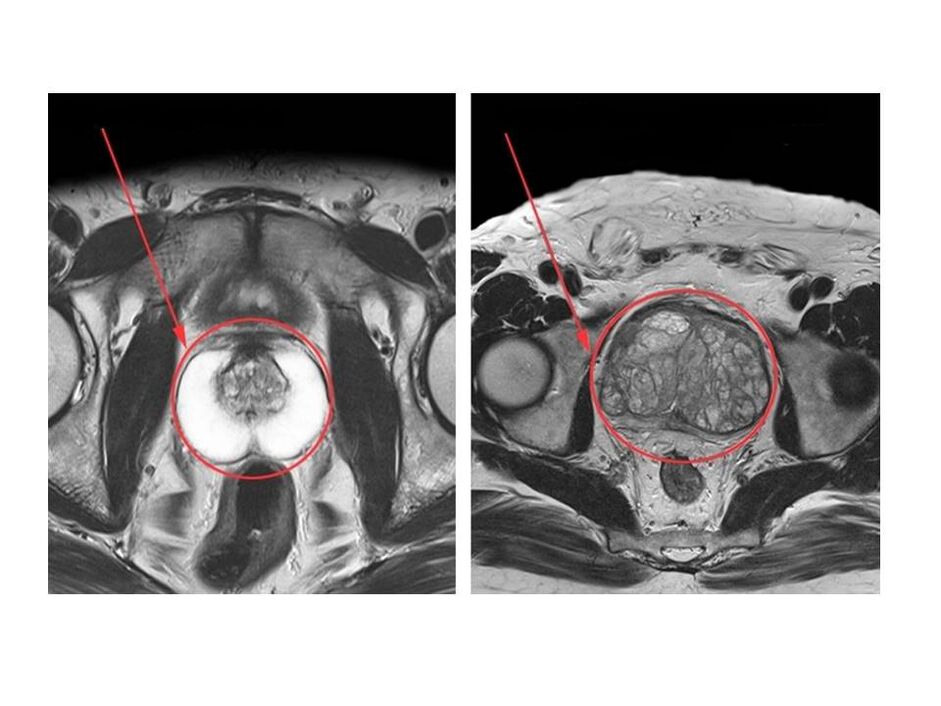 Comparison of healthy (left) and inflamed (right) prostates on MRI images