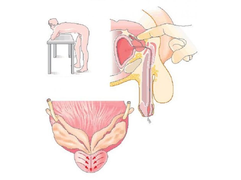 Doctor's prostate massage technique to analyze secretions